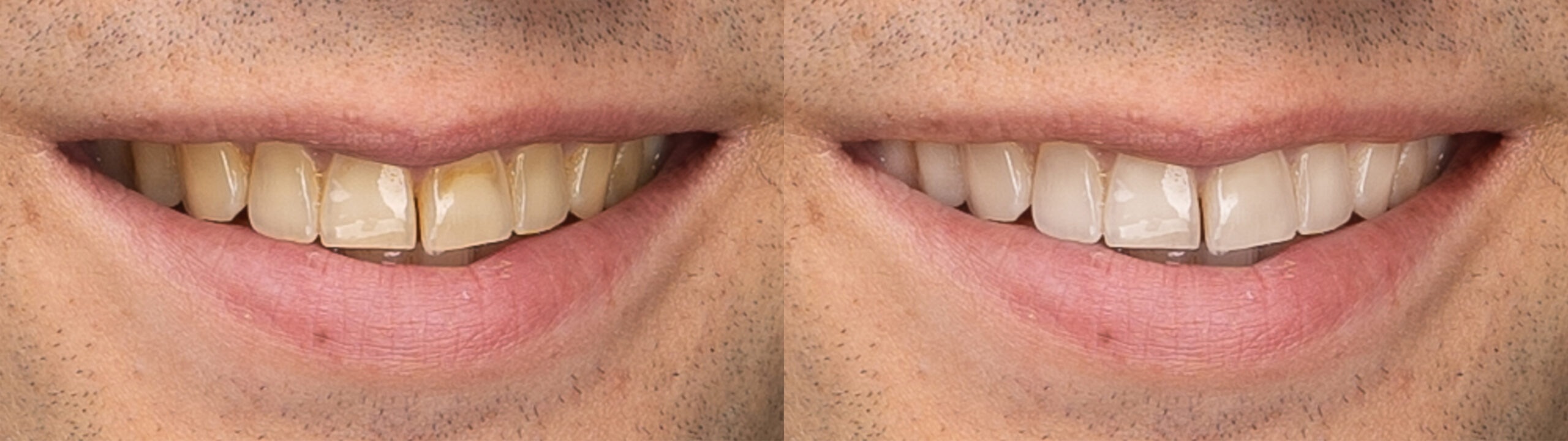 Teeth-Whitening-v2 teeth whitening